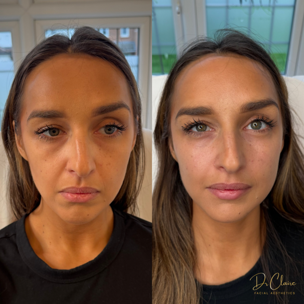 Transformations | Dr Claire Facial Aesthetics | Botox Chorley | Fillers Chorley | Aesthetics Chorley | Botox Treatments Chorley | Dermal Fillers Chorley | Aesthetic Enhancements Chorley