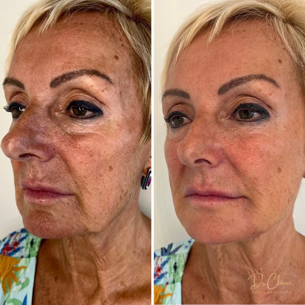 Transformations | Dr Claire Facial Aesthetics | Botox Chorley | Fillers Chorley | Aesthetics Chorley | Botox Treatments Chorley | Dermal Fillers Chorley | Aesthetic Enhancements Chorley