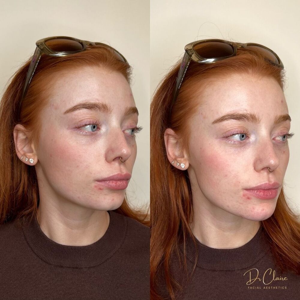 Transformations | Dr Claire Facial Aesthetics | Botox Chorley | Fillers Chorley | Aesthetics Chorley | Botox Treatments Chorley | Dermal Fillers Chorley | Aesthetic Enhancements Chorley