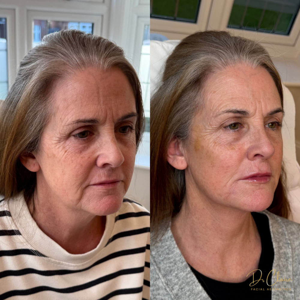 Transformations | Dr Claire Facial Aesthetics | Botox Chorley | Fillers Chorley | Aesthetics Chorley | Botox Treatments Chorley | Dermal Fillers Chorley | Aesthetic Enhancements Chorley