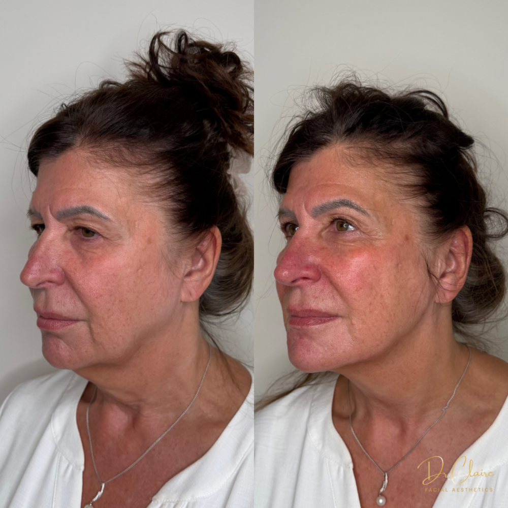 Transformations | Dr Claire Facial Aesthetics | Botox Chorley | Fillers Chorley | Aesthetics Chorley | Botox Treatments Chorley | Dermal Fillers Chorley | Aesthetic Enhancements Chorley
