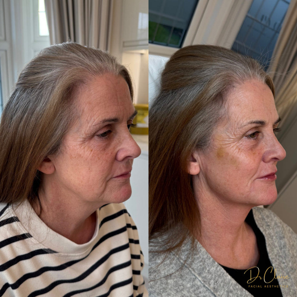 Transformations | Dr Claire Facial Aesthetics | Botox Chorley | Fillers Chorley | Aesthetics Chorley | Botox Treatments Chorley | Dermal Fillers Chorley | Aesthetic Enhancements Chorley