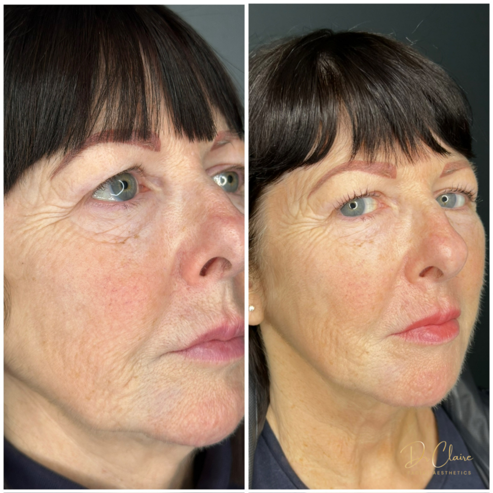 Transformations | Dr Claire Facial Aesthetics | Botox Chorley | Fillers Chorley | Aesthetics Chorley | Botox Treatments Chorley | Dermal Fillers Chorley | Aesthetic Enhancements Chorley