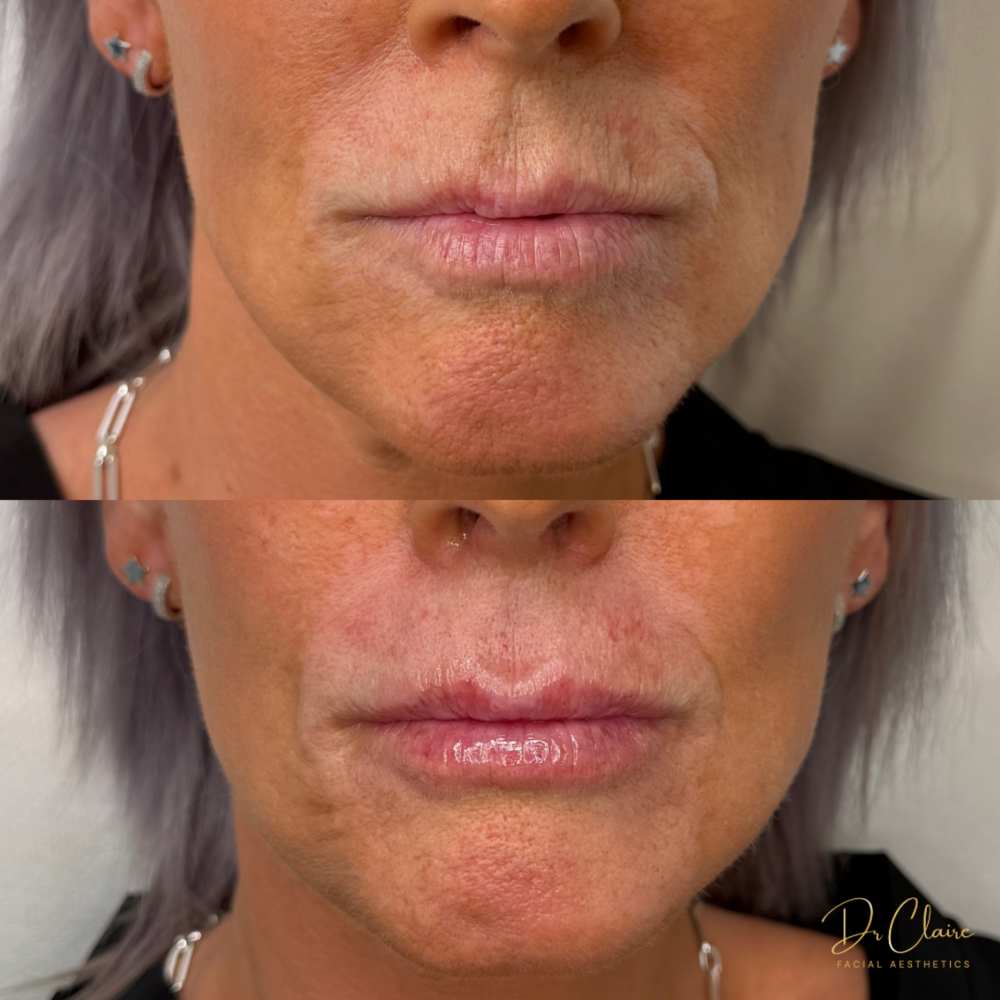 Transformations | Dr Claire Facial Aesthetics | Botox Chorley | Fillers Chorley | Aesthetics Chorley | Botox Treatments Chorley | Dermal Fillers Chorley | Aesthetic Enhancements Chorley