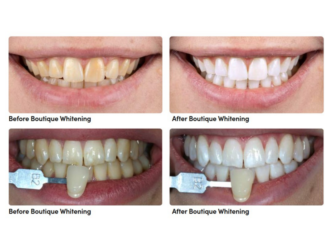 Teeth Whitening | Cramond House Dental Practice | Dentist Clitheroe Preston Manchester | Dental Implants Clitheroe Preston Manchester | Gum Surgery Clitheroe Preston Manchester