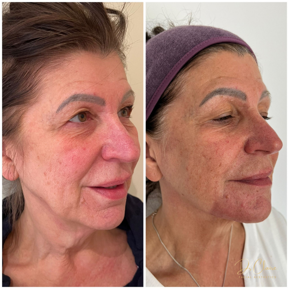 Transformations | Dr Claire Facial Aesthetics | Botox Chorley | Fillers Chorley | Aesthetics Chorley | Botox Treatments Chorley | Dermal Fillers Chorley | Aesthetic Enhancements Chorley