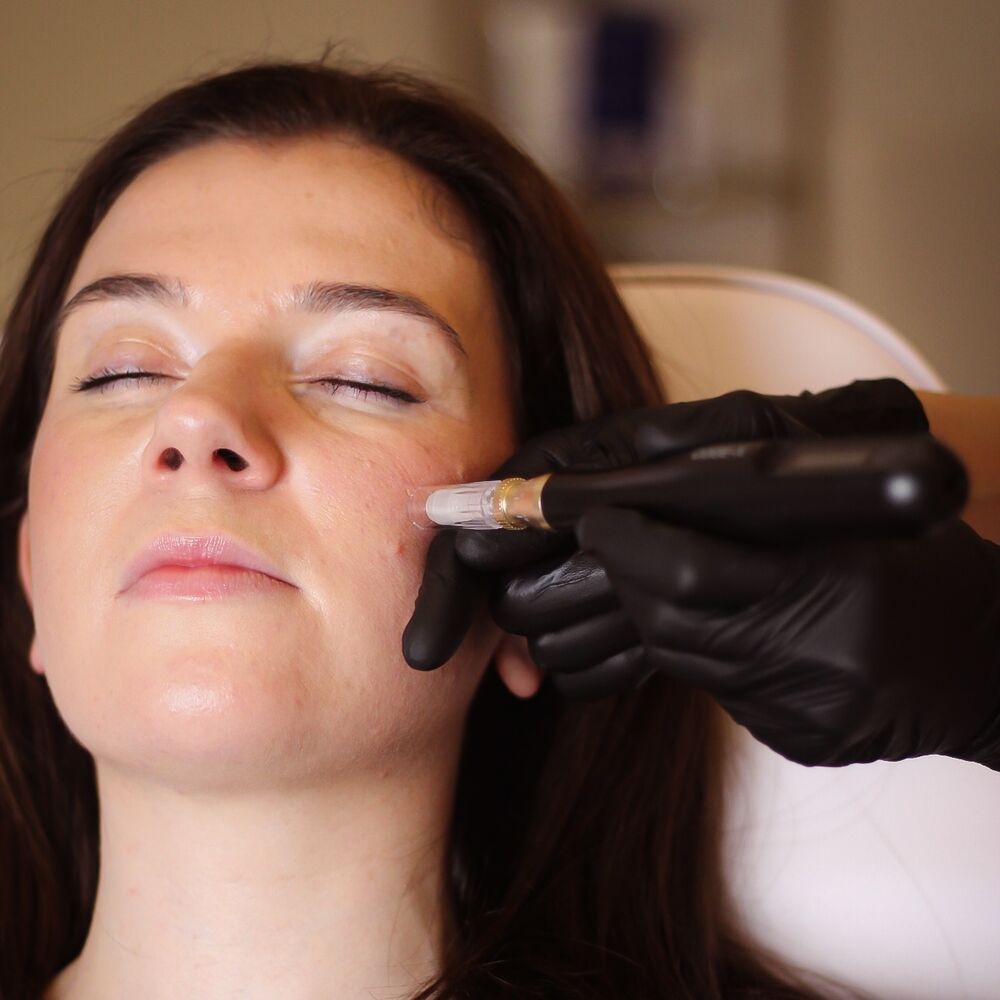 Medical Microneedling +/- Exosomes