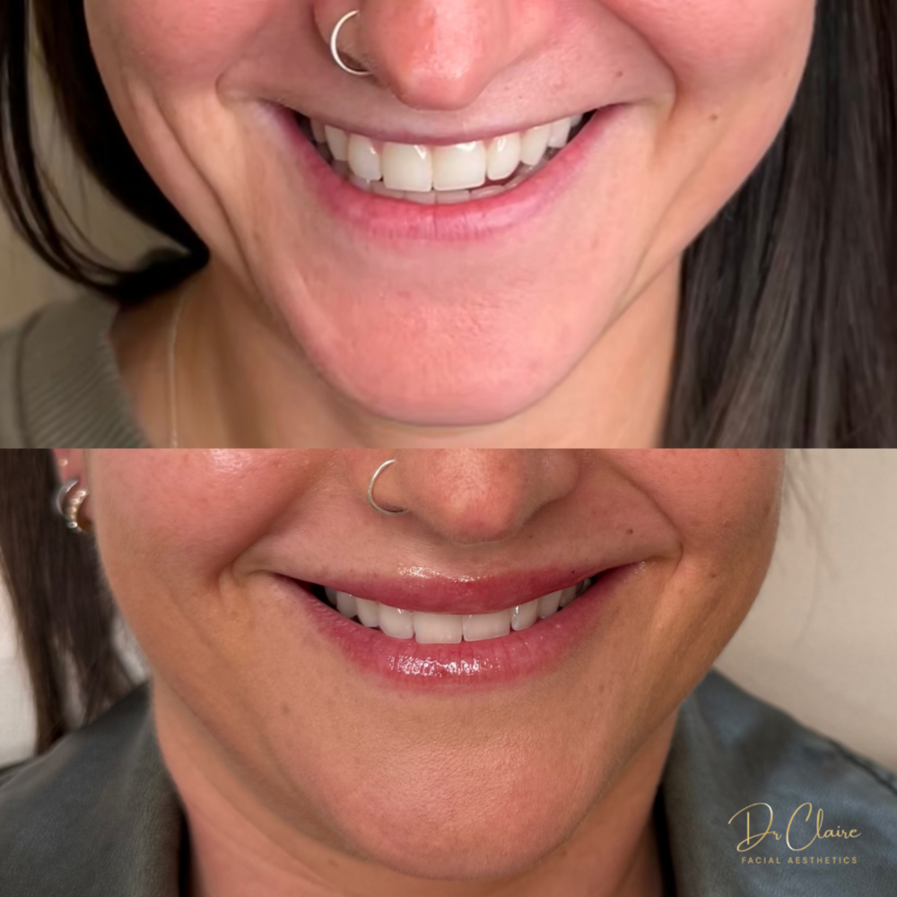 Transformations | Dr Claire Facial Aesthetics | Botox Chorley | Fillers Chorley | Aesthetics Chorley | Botox Treatments Chorley | Dermal Fillers Chorley | Aesthetic Enhancements Chorley