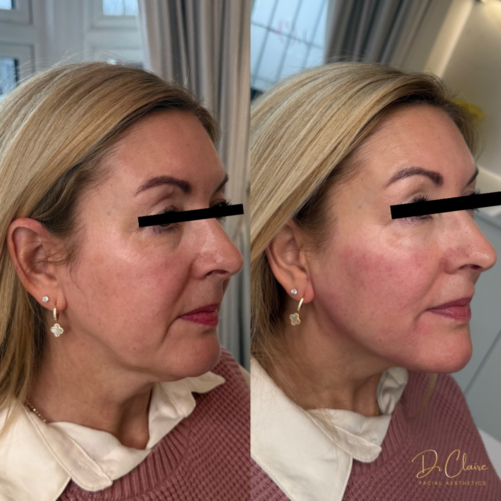Transformations | Dr Claire Facial Aesthetics | Botox Chorley | Fillers Chorley | Aesthetics Chorley | Botox Treatments Chorley | Dermal Fillers Chorley | Aesthetic Enhancements Chorley