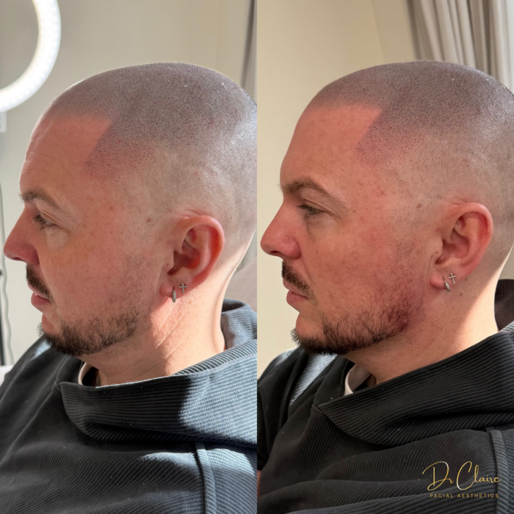 Transformations | Dr Claire Facial Aesthetics | Botox Chorley | Fillers Chorley | Aesthetics Chorley | Botox Treatments Chorley | Dermal Fillers Chorley | Aesthetic Enhancements Chorley