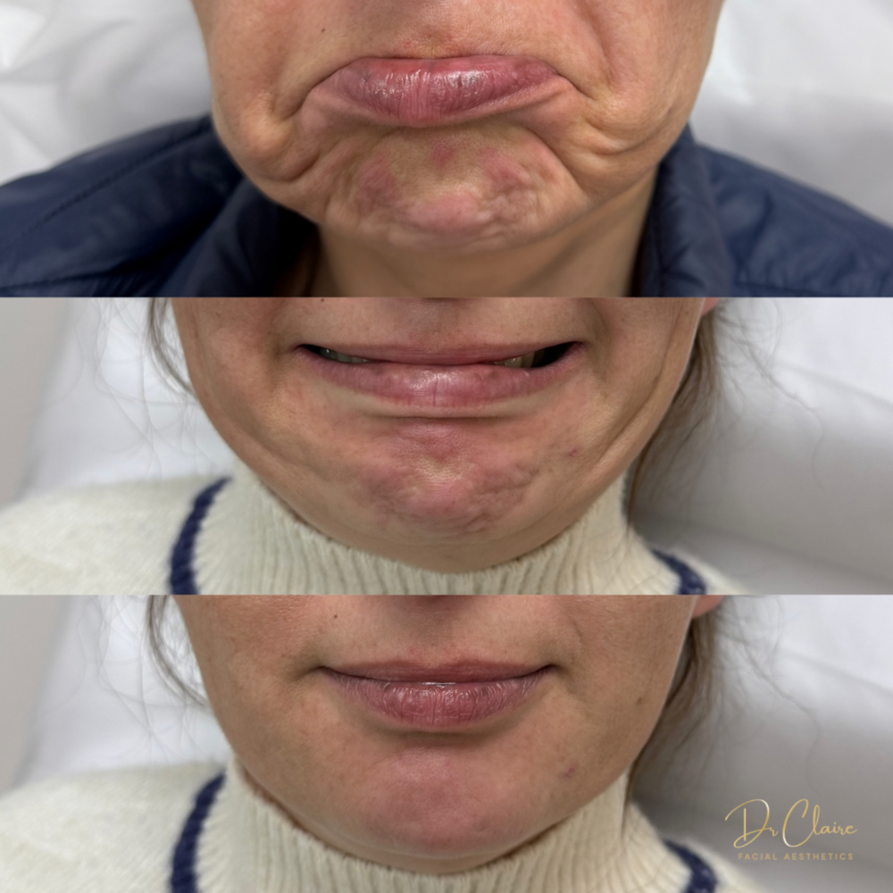 Transformations | Dr Claire Facial Aesthetics | Botox Chorley | Fillers Chorley | Aesthetics Chorley | Botox Treatments Chorley | Dermal Fillers Chorley | Aesthetic Enhancements Chorley
