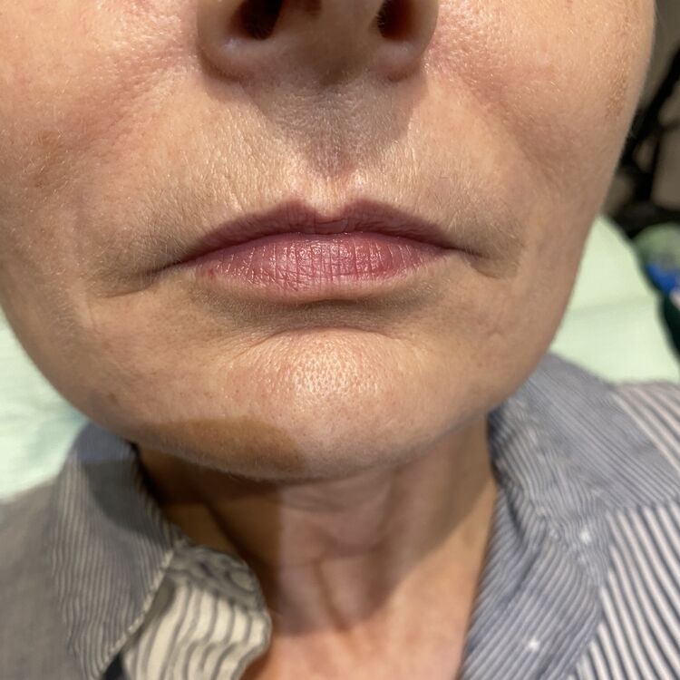 Before & After Results