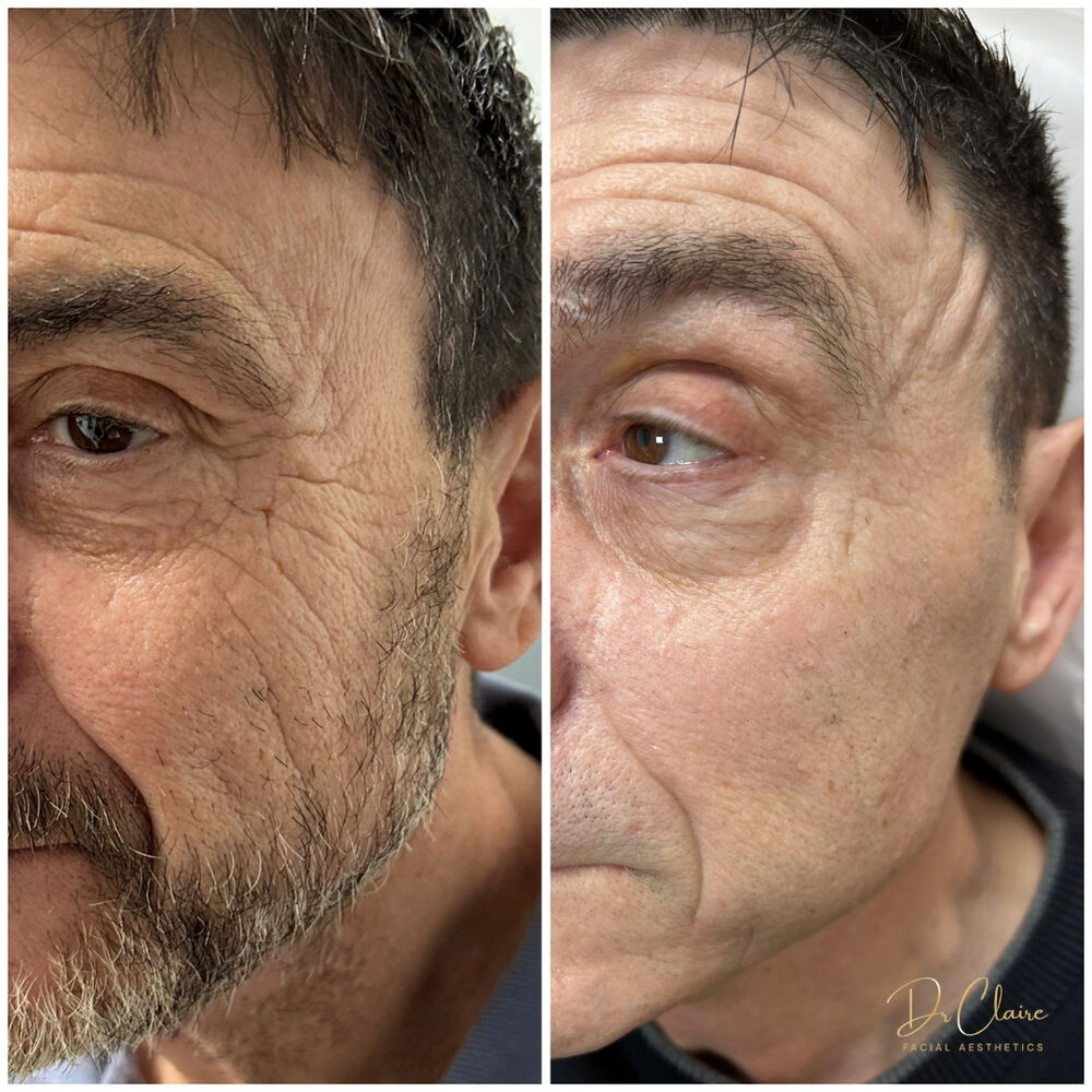 Transformations | Dr Claire Facial Aesthetics | Botox Chorley | Fillers Chorley | Aesthetics Chorley | Botox Treatments Chorley | Dermal Fillers Chorley | Aesthetic Enhancements Chorley