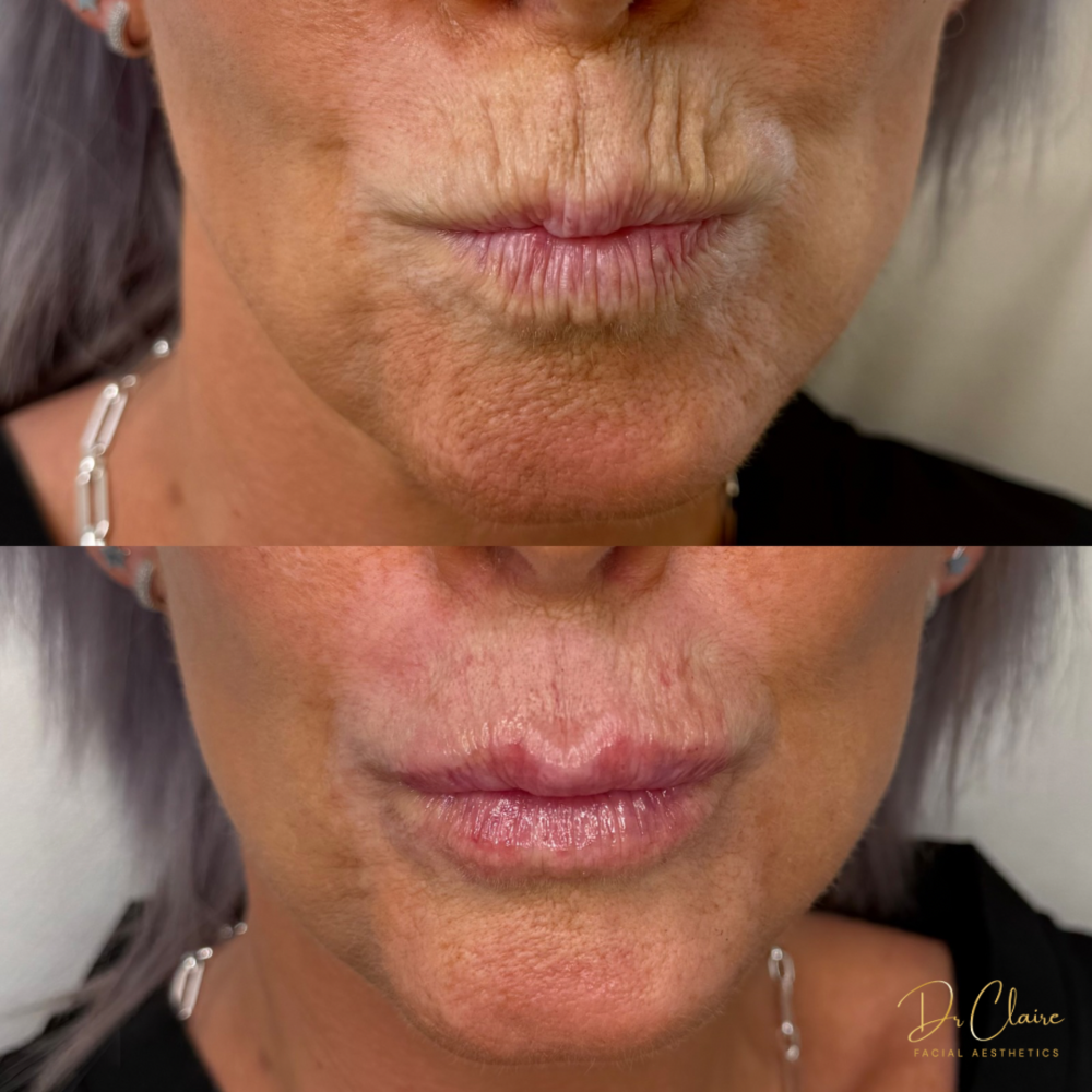 Transformations | Dr Claire Facial Aesthetics | Botox Chorley | Fillers Chorley | Aesthetics Chorley | Botox Treatments Chorley | Dermal Fillers Chorley | Aesthetic Enhancements Chorley