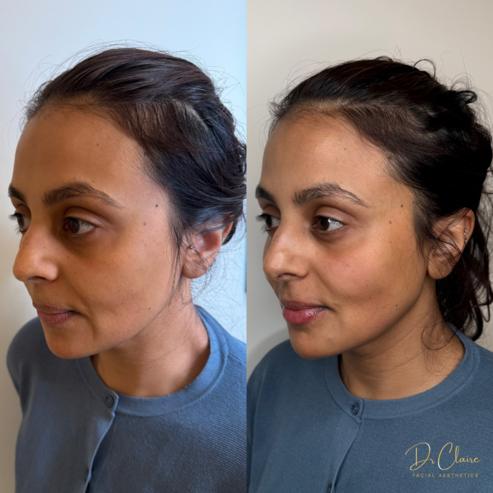 Transformations | Dr Claire Facial Aesthetics | Botox Chorley | Fillers Chorley | Aesthetics Chorley | Botox Treatments Chorley | Dermal Fillers Chorley | Aesthetic Enhancements Chorley