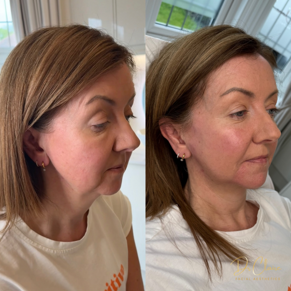 Transformations | Dr Claire Facial Aesthetics | Botox Chorley | Fillers Chorley | Aesthetics Chorley | Botox Treatments Chorley | Dermal Fillers Chorley | Aesthetic Enhancements Chorley