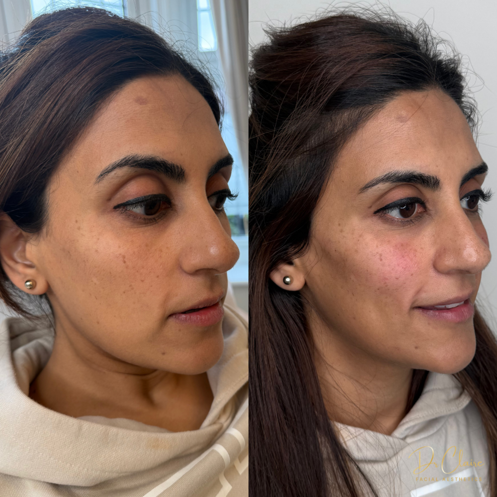 Transformations | Dr Claire Facial Aesthetics | Botox Chorley | Fillers Chorley | Aesthetics Chorley | Botox Treatments Chorley | Dermal Fillers Chorley | Aesthetic Enhancements Chorley