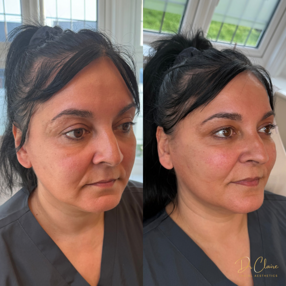 Transformations | Dr Claire Facial Aesthetics | Botox Chorley | Fillers Chorley | Aesthetics Chorley | Botox Treatments Chorley | Dermal Fillers Chorley | Aesthetic Enhancements Chorley