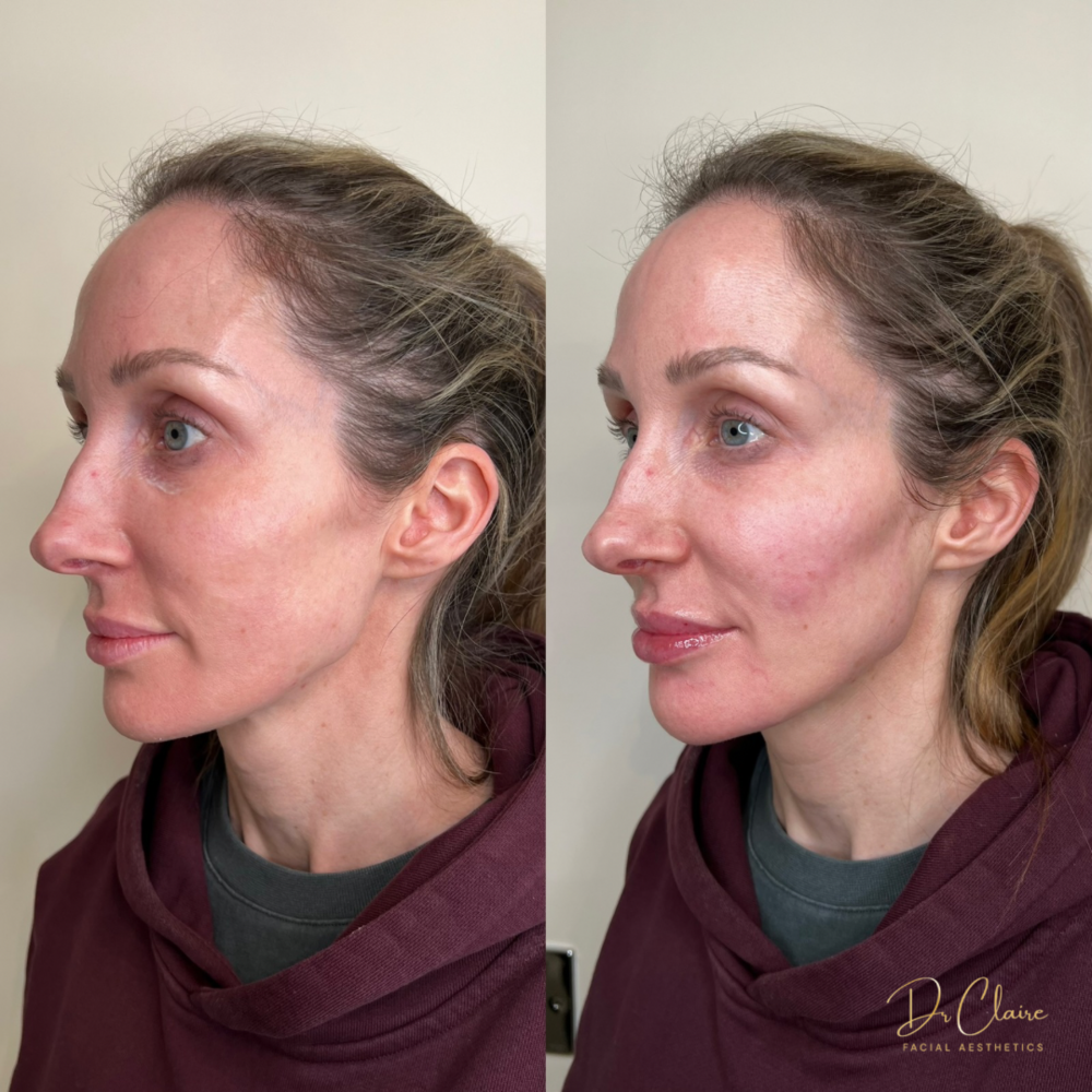 Transformations | Dr Claire Facial Aesthetics | Botox Chorley | Fillers Chorley | Aesthetics Chorley | Botox Treatments Chorley | Dermal Fillers Chorley | Aesthetic Enhancements Chorley