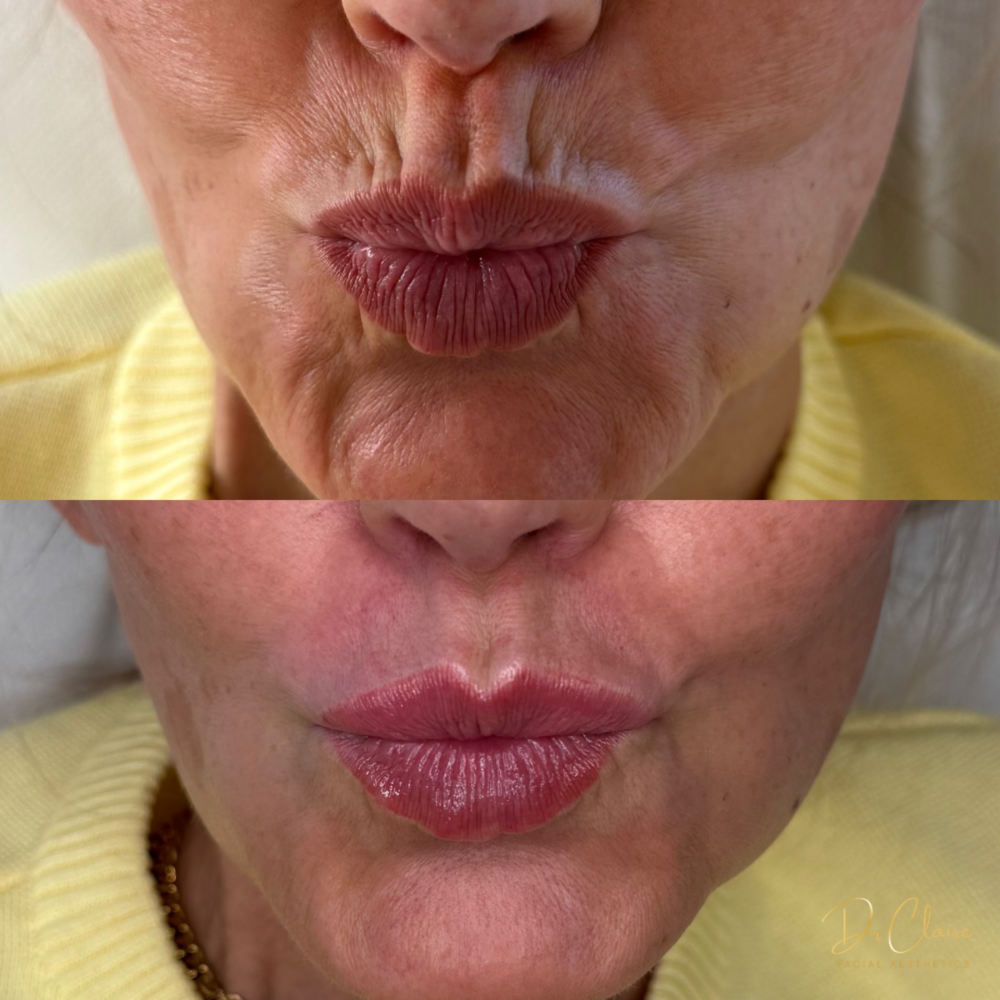Transformations | Dr Claire Facial Aesthetics | Botox Chorley | Fillers Chorley | Aesthetics Chorley | Botox Treatments Chorley | Dermal Fillers Chorley | Aesthetic Enhancements Chorley