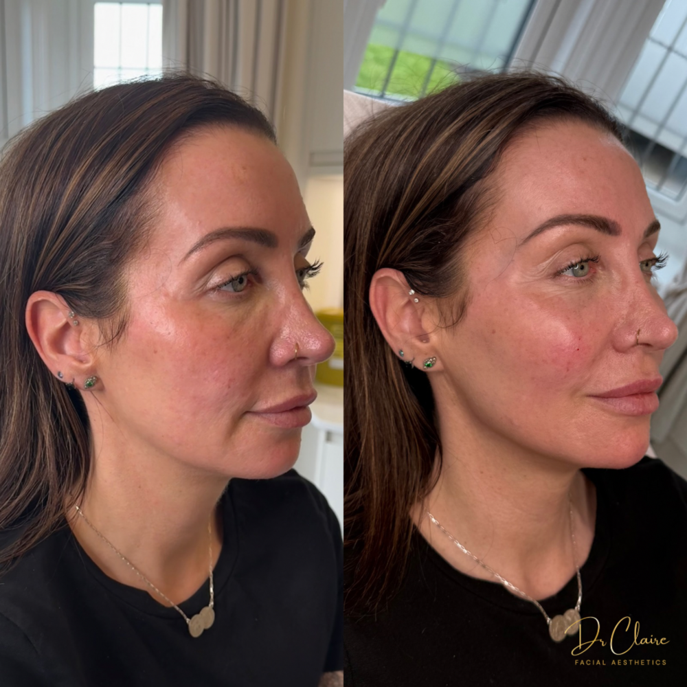 Transformations | Dr Claire Facial Aesthetics | Botox Chorley | Fillers Chorley | Aesthetics Chorley | Botox Treatments Chorley | Dermal Fillers Chorley | Aesthetic Enhancements Chorley