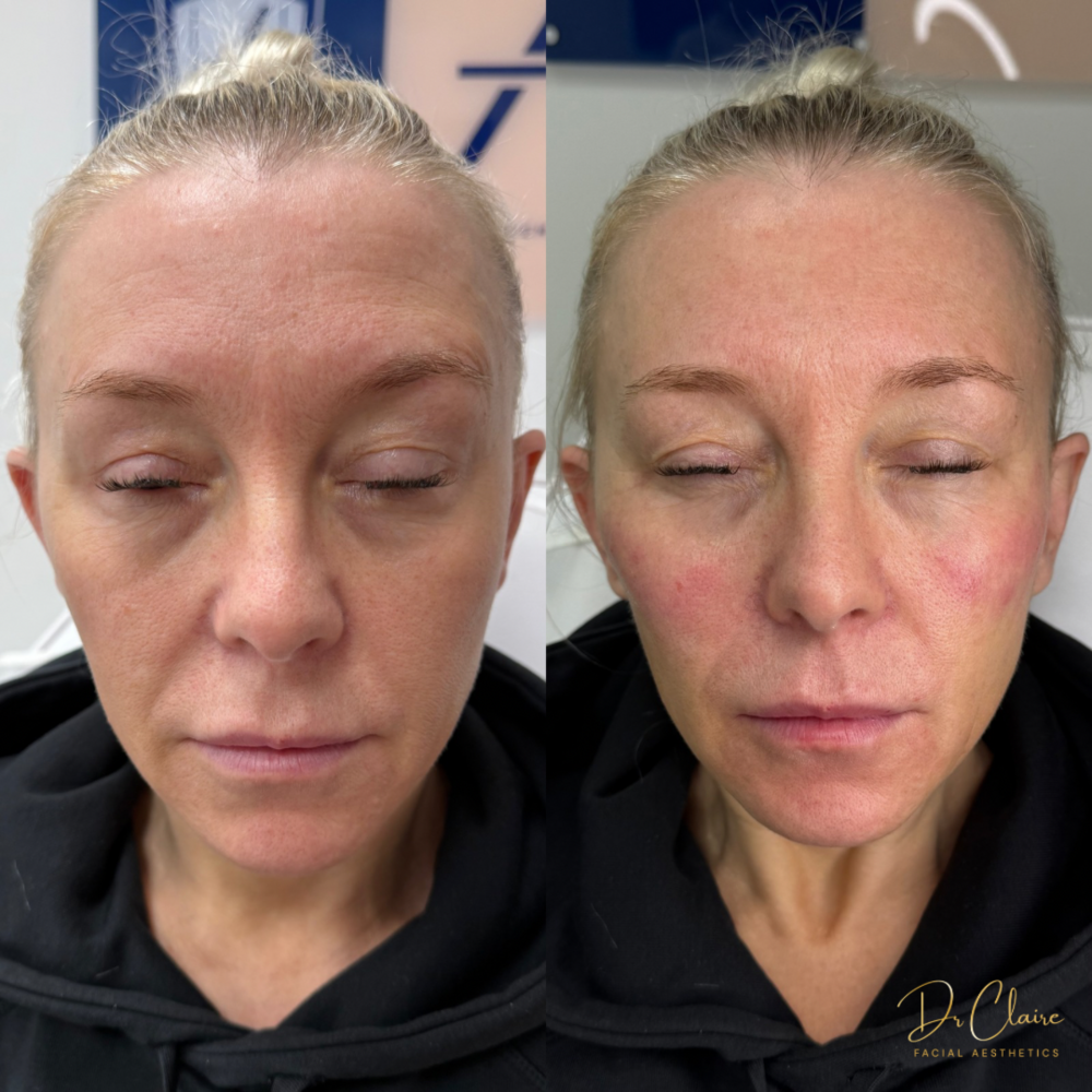 Transformations | Dr Claire Facial Aesthetics | Botox Chorley | Fillers Chorley | Aesthetics Chorley | Botox Treatments Chorley | Dermal Fillers Chorley | Aesthetic Enhancements Chorley