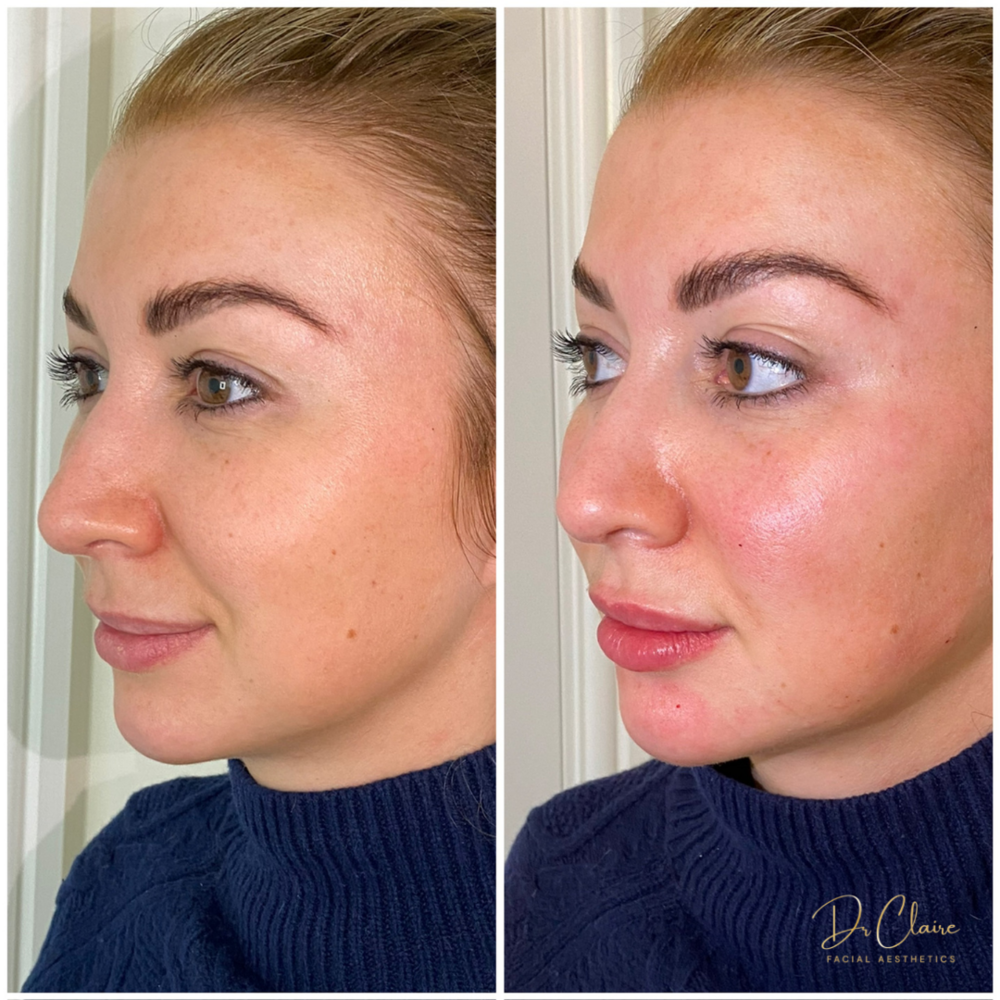 Transformations | Dr Claire Facial Aesthetics | Botox Chorley | Fillers Chorley | Aesthetics Chorley | Botox Treatments Chorley | Dermal Fillers Chorley | Aesthetic Enhancements Chorley