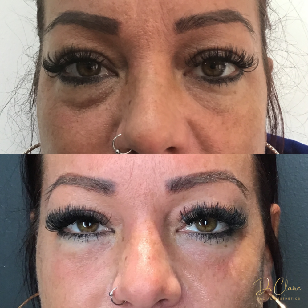 Transformations | Dr Claire Facial Aesthetics | Botox Chorley | Fillers Chorley | Aesthetics Chorley | Botox Treatments Chorley | Dermal Fillers Chorley | Aesthetic Enhancements Chorley