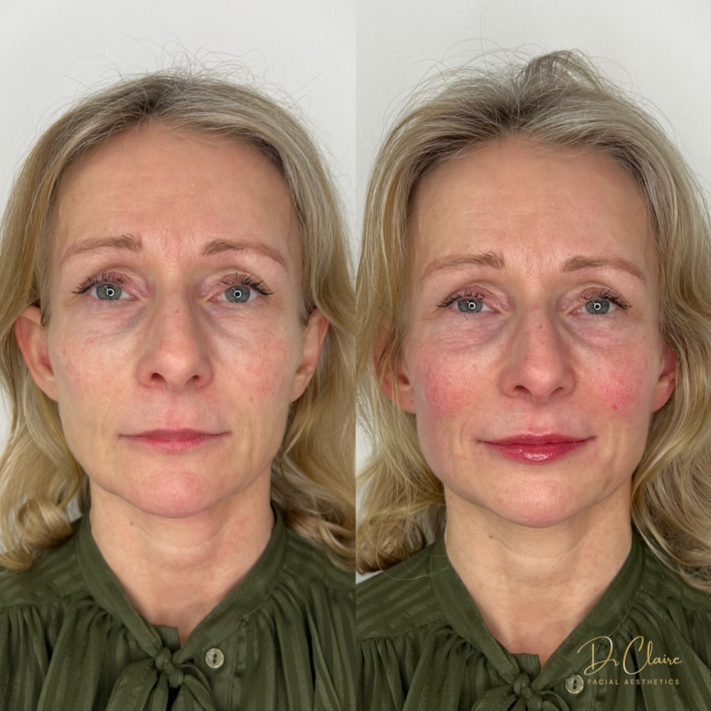 Transformations | Dr Claire Facial Aesthetics | Botox Chorley | Fillers Chorley | Aesthetics Chorley | Botox Treatments Chorley | Dermal Fillers Chorley | Aesthetic Enhancements Chorley