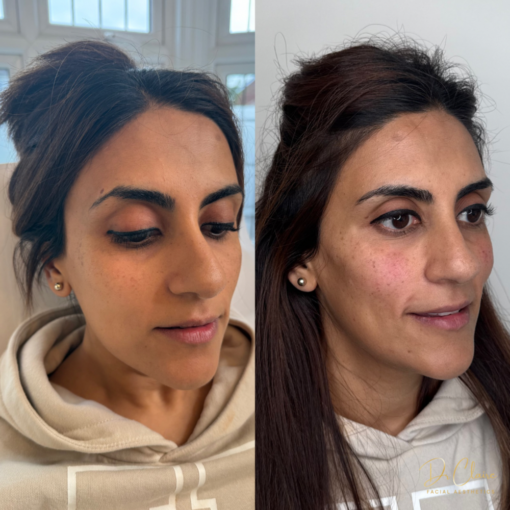 Transformations | Dr Claire Facial Aesthetics | Botox Chorley | Fillers Chorley | Aesthetics Chorley | Botox Treatments Chorley | Dermal Fillers Chorley | Aesthetic Enhancements Chorley