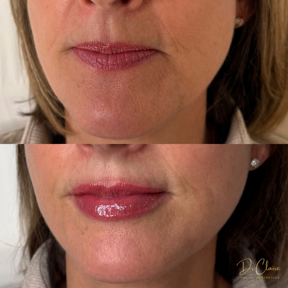 Transformations | Dr Claire Facial Aesthetics | Botox Chorley | Fillers Chorley | Aesthetics Chorley | Botox Treatments Chorley | Dermal Fillers Chorley | Aesthetic Enhancements Chorley