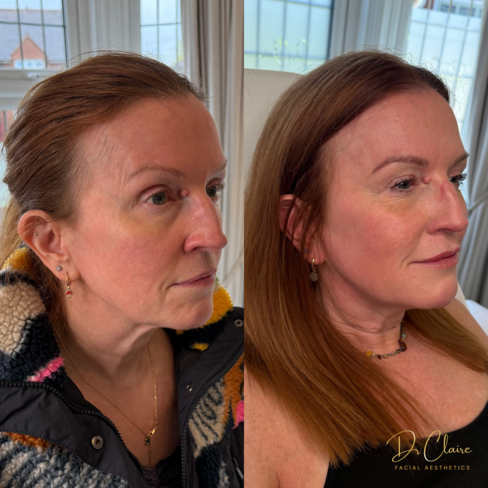 Transformations | Dr Claire Facial Aesthetics | Botox Chorley | Fillers Chorley | Aesthetics Chorley | Botox Treatments Chorley | Dermal Fillers Chorley | Aesthetic Enhancements Chorley