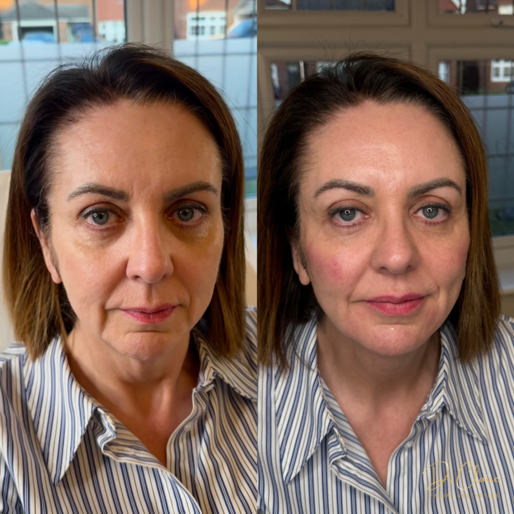 Transformations | Dr Claire Facial Aesthetics | Botox Chorley | Fillers Chorley | Aesthetics Chorley | Botox Treatments Chorley | Dermal Fillers Chorley | Aesthetic Enhancements Chorley