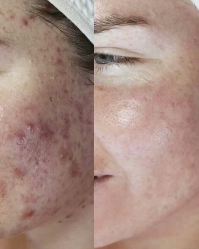 DERMULUX LED LIGHT THERAPY/ MICRODERM