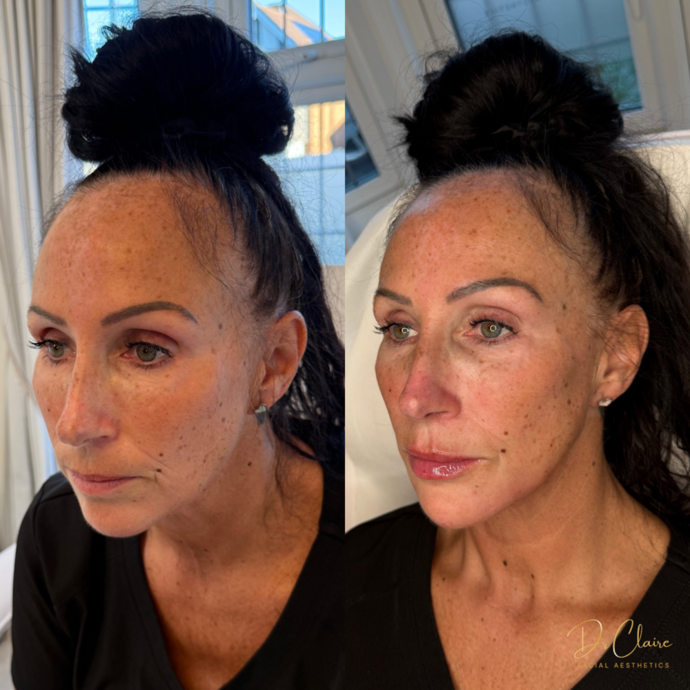 Transformations | Dr Claire Facial Aesthetics | Botox Chorley | Fillers Chorley | Aesthetics Chorley | Botox Treatments Chorley | Dermal Fillers Chorley | Aesthetic Enhancements Chorley