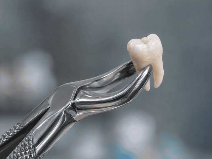 Tooth Extractions | Cramond House Dental Practice | Dentist Clitheroe Preston Manchester | Dental Implants Clitheroe Preston Manchester | Gum Surgery Clitheroe Preston Manchester