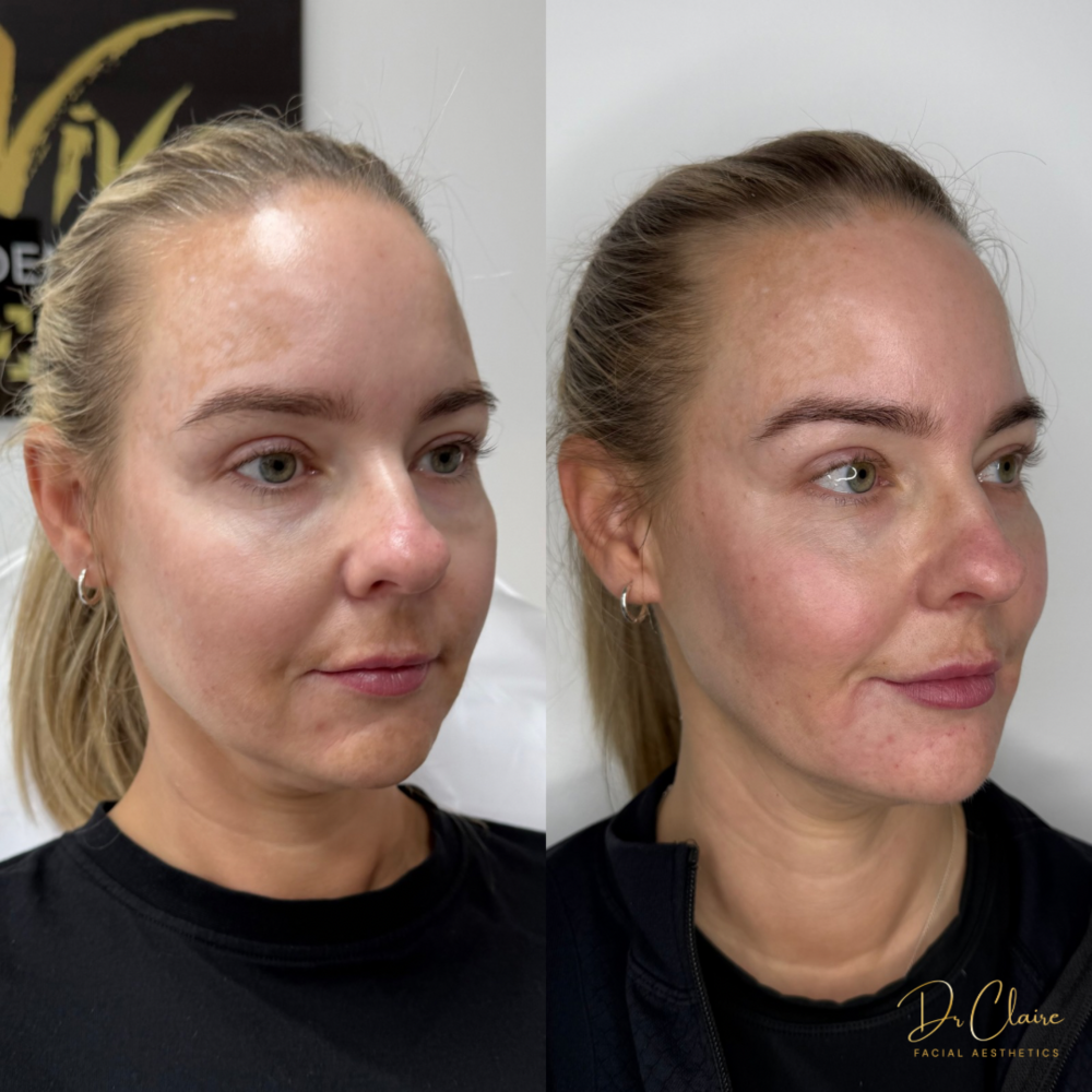 Transformations | Dr Claire Facial Aesthetics | Botox Chorley | Fillers Chorley | Aesthetics Chorley | Botox Treatments Chorley | Dermal Fillers Chorley | Aesthetic Enhancements Chorley