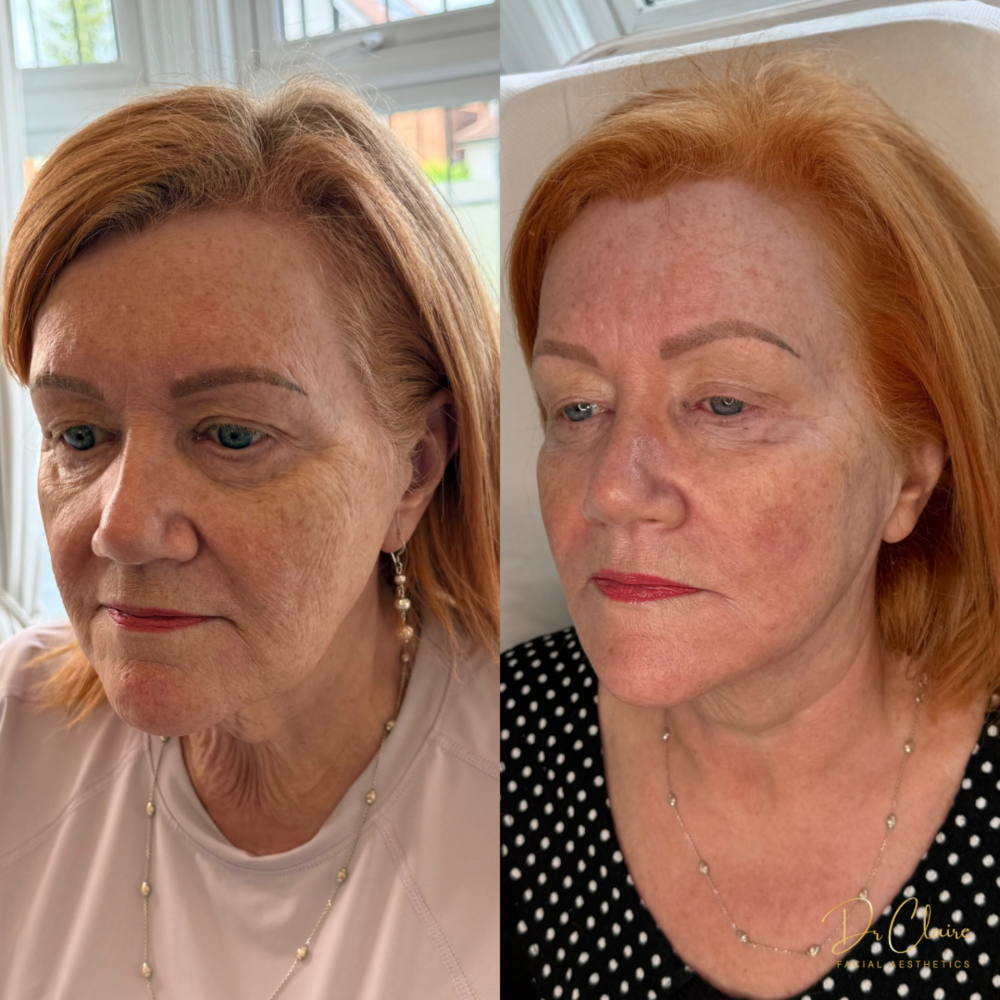 Transformations | Dr Claire Facial Aesthetics | Botox Chorley | Fillers Chorley | Aesthetics Chorley | Botox Treatments Chorley | Dermal Fillers Chorley | Aesthetic Enhancements Chorley