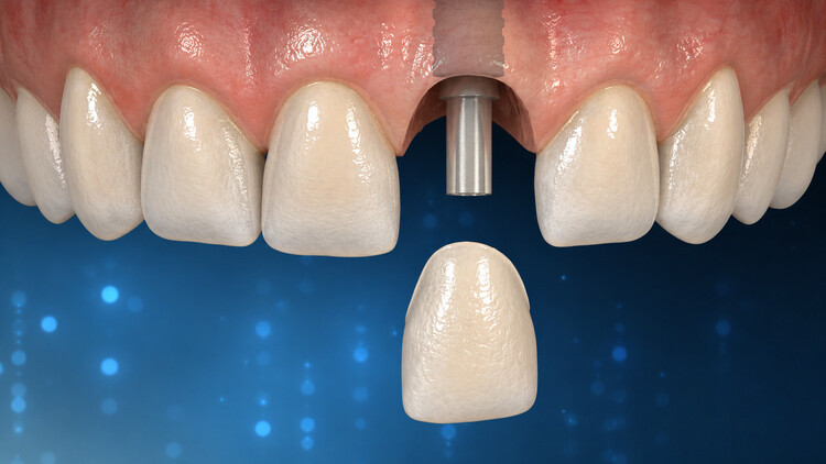 Advanced Dentistry | Cramond House Dental Practice | Dentist Clitheroe Preston Manchester | Dental Implants Clitheroe Preston Manchester | Gum Surgery Clitheroe Preston Manchester