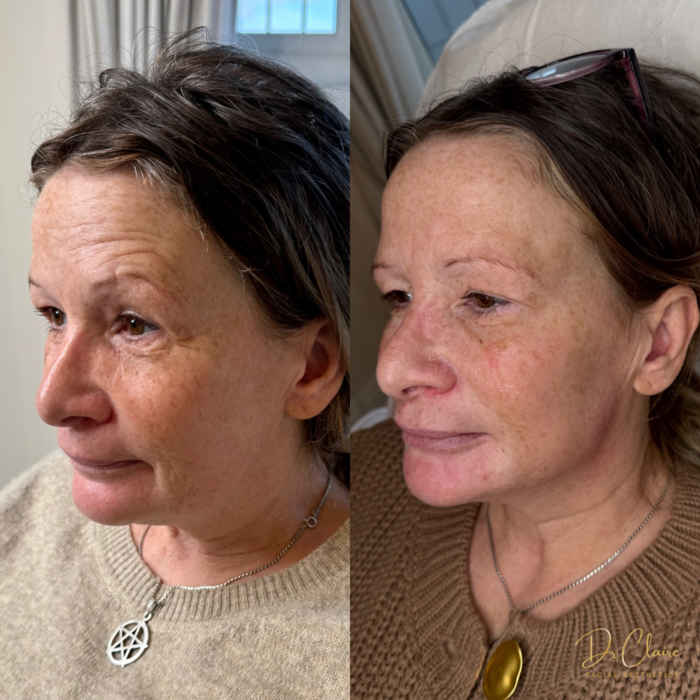 Transformations | Dr Claire Facial Aesthetics | Botox Chorley | Fillers Chorley | Aesthetics Chorley | Botox Treatments Chorley | Dermal Fillers Chorley | Aesthetic Enhancements Chorley