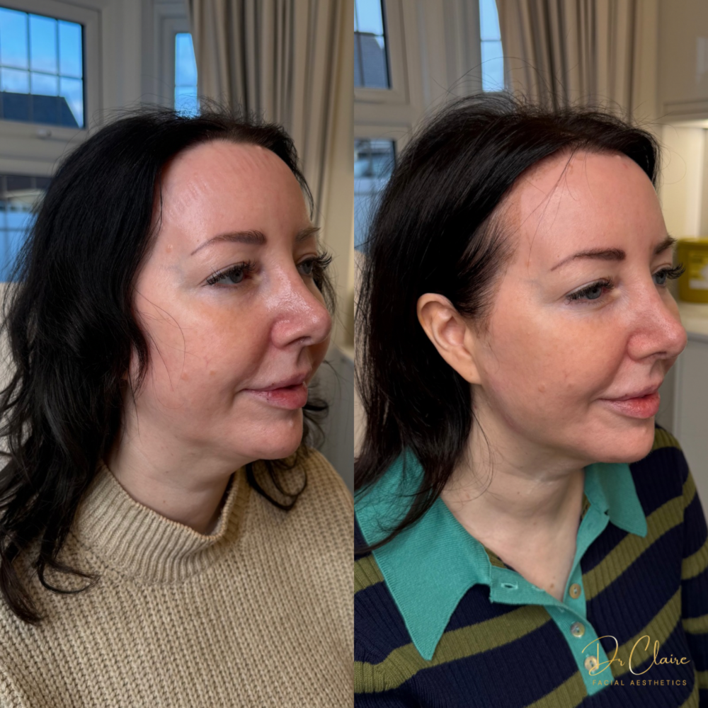 Transformations | Dr Claire Facial Aesthetics | Botox Chorley | Fillers Chorley | Aesthetics Chorley | Botox Treatments Chorley | Dermal Fillers Chorley | Aesthetic Enhancements Chorley