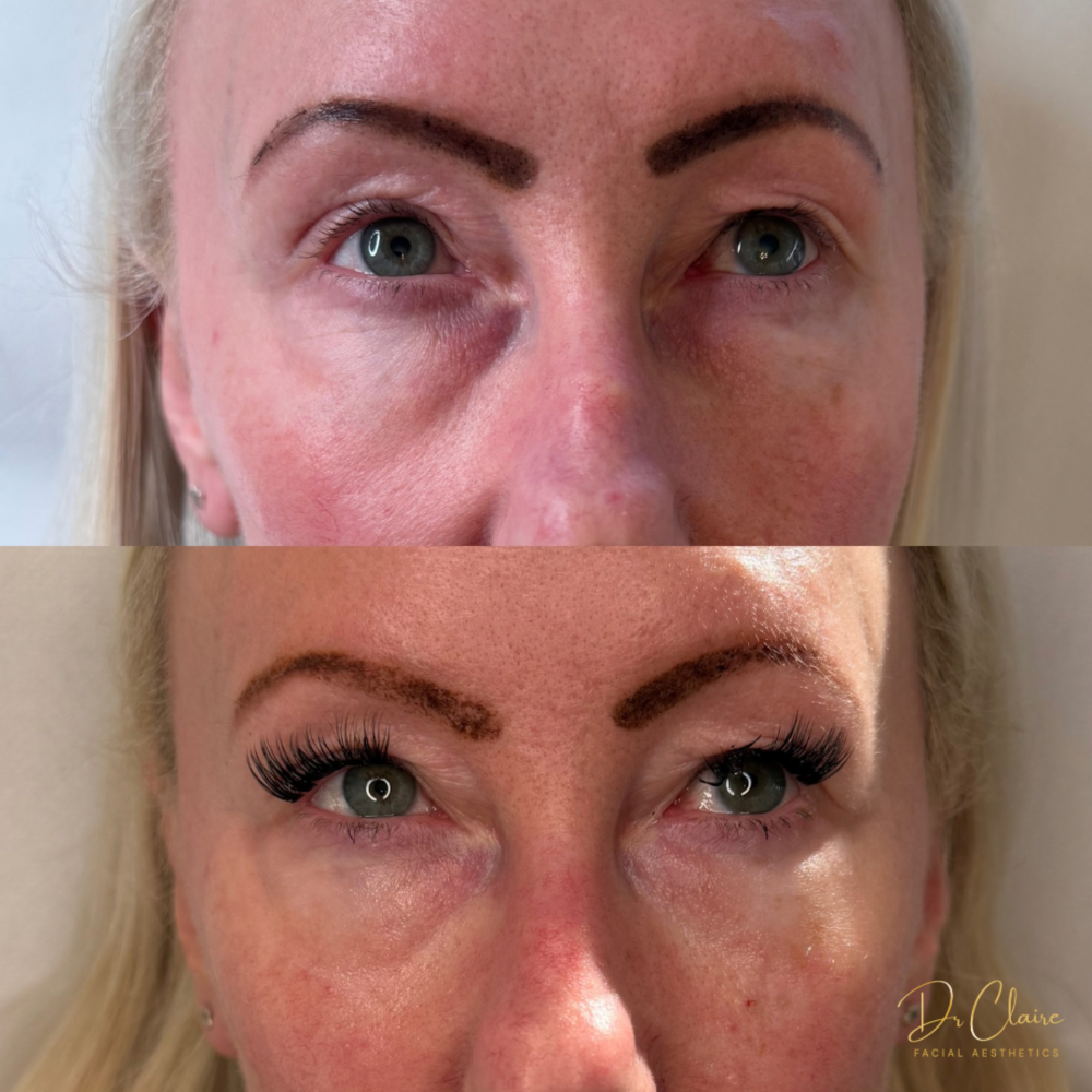Transformations | Dr Claire Facial Aesthetics | Botox Chorley | Fillers Chorley | Aesthetics Chorley | Botox Treatments Chorley | Dermal Fillers Chorley | Aesthetic Enhancements Chorley