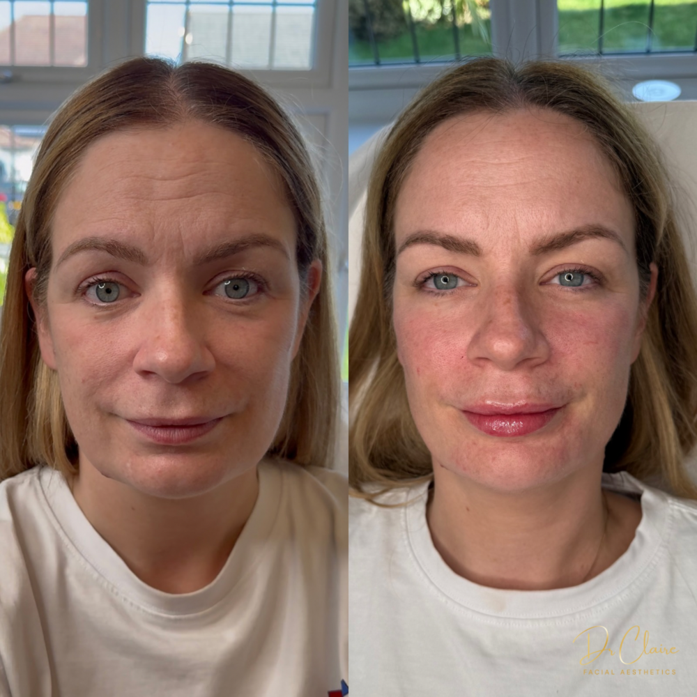 Transformations | Dr Claire Facial Aesthetics | Botox Chorley | Fillers Chorley | Aesthetics Chorley | Botox Treatments Chorley | Dermal Fillers Chorley | Aesthetic Enhancements Chorley