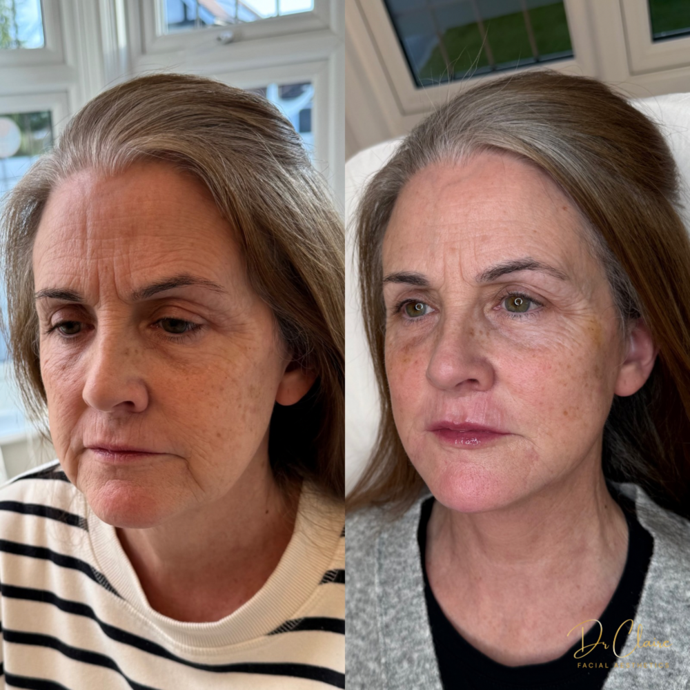 Transformations | Dr Claire Facial Aesthetics | Botox Chorley | Fillers Chorley | Aesthetics Chorley | Botox Treatments Chorley | Dermal Fillers Chorley | Aesthetic Enhancements Chorley