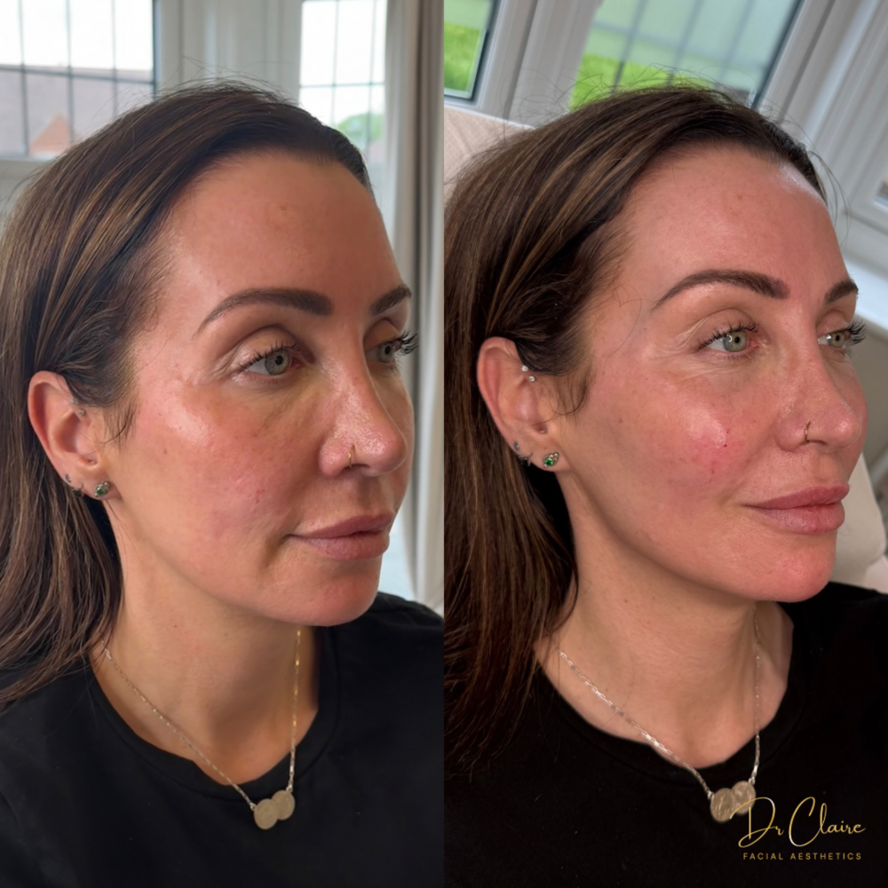 Transformations | Dr Claire Facial Aesthetics | Botox Chorley | Fillers Chorley | Aesthetics Chorley | Botox Treatments Chorley | Dermal Fillers Chorley | Aesthetic Enhancements Chorley