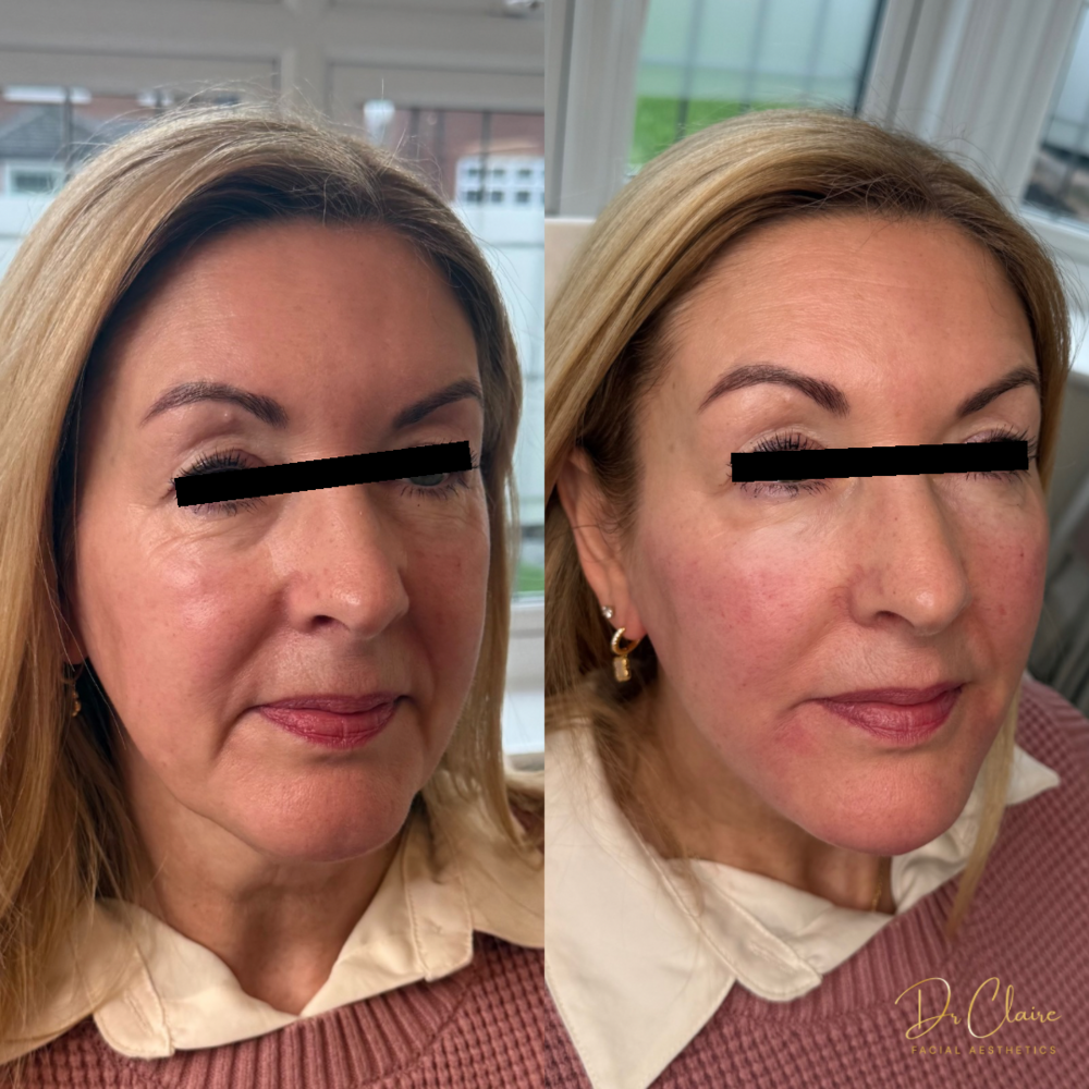 Transformations | Dr Claire Facial Aesthetics | Botox Chorley | Fillers Chorley | Aesthetics Chorley | Botox Treatments Chorley | Dermal Fillers Chorley | Aesthetic Enhancements Chorley