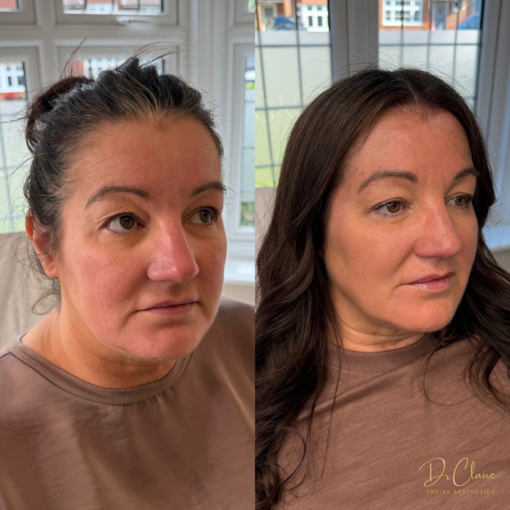Transformations | Dr Claire Facial Aesthetics | Botox Chorley | Fillers Chorley | Aesthetics Chorley | Botox Treatments Chorley | Dermal Fillers Chorley | Aesthetic Enhancements Chorley