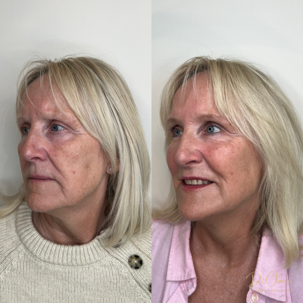 Transformations | Dr Claire Facial Aesthetics | Botox Chorley | Fillers Chorley | Aesthetics Chorley | Botox Treatments Chorley | Dermal Fillers Chorley | Aesthetic Enhancements Chorley