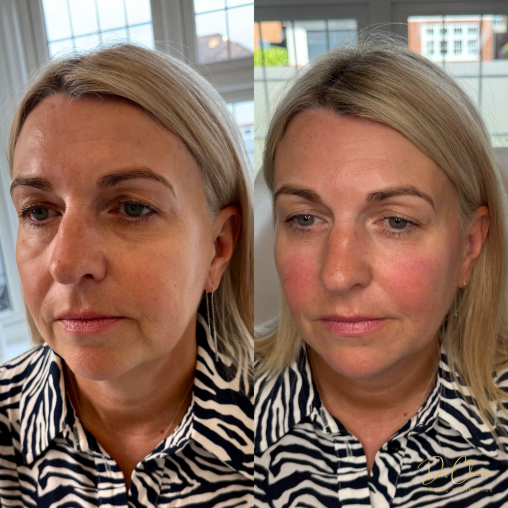Transformations | Dr Claire Facial Aesthetics | Botox Chorley | Fillers Chorley | Aesthetics Chorley | Botox Treatments Chorley | Dermal Fillers Chorley | Aesthetic Enhancements Chorley