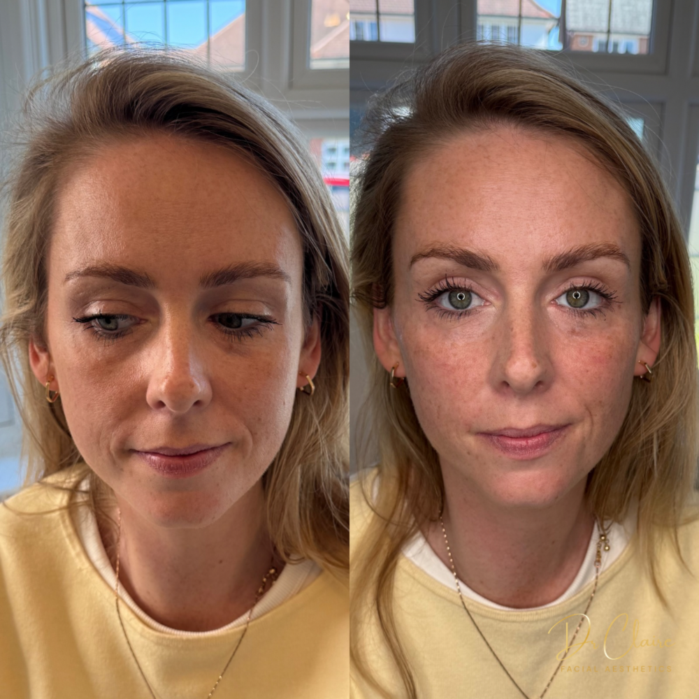 Transformations | Dr Claire Facial Aesthetics | Botox Chorley | Fillers Chorley | Aesthetics Chorley | Botox Treatments Chorley | Dermal Fillers Chorley | Aesthetic Enhancements Chorley